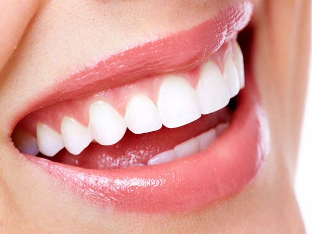 RĂNG SỨ VENEER